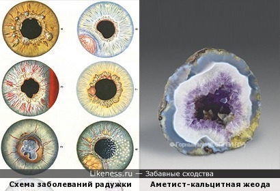 Аметист-кальцитная жеода в разрезе и схематическое изображение заболеваний радужной оболочки