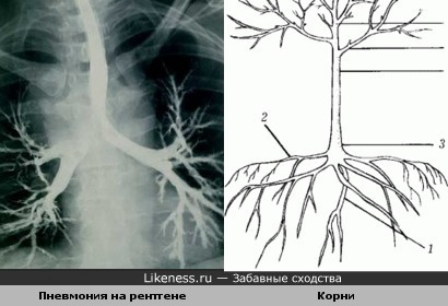 пневмония на рентгентовском снимке напоминает корни